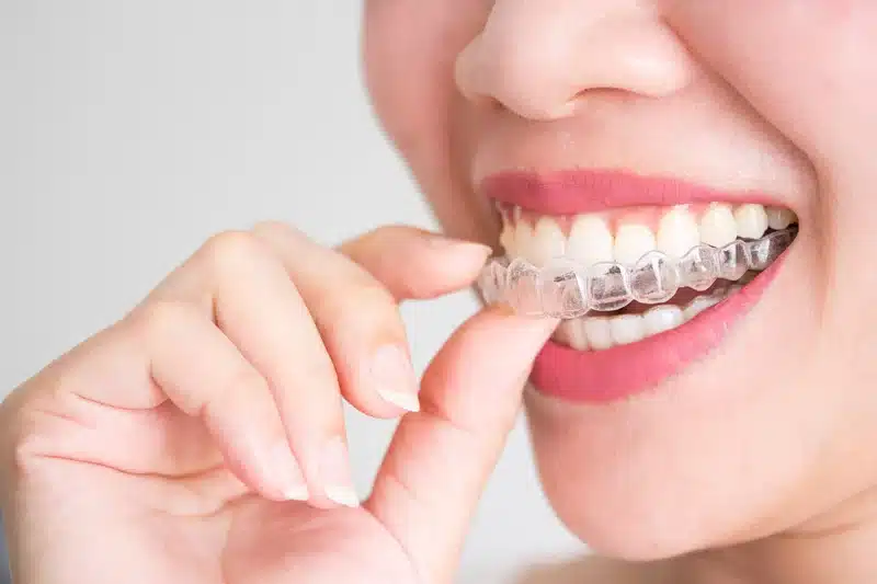 Invisalign